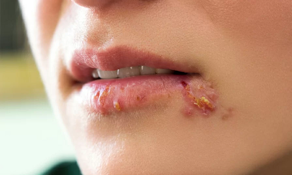 Beispiel von Lippen-Herpes