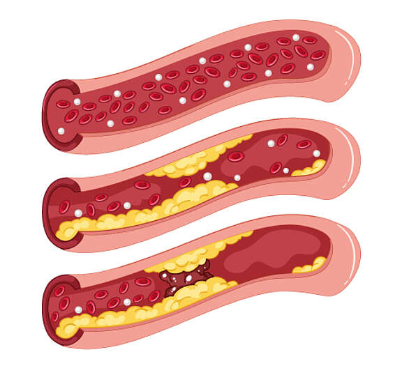 Grafische Darstellung: Entstehung von Arteriosklerose. Erkennbar sind eine Arterie, Plaques und rote Blutkörperchen. Der Blutfluss ist zunehmend erschwert.